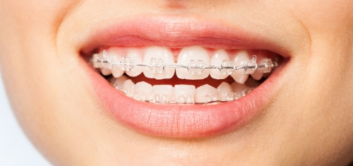 Ceramic Braces